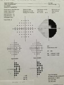 My visual field test which shows homonymous hemianopsia (black is where I can not see)
