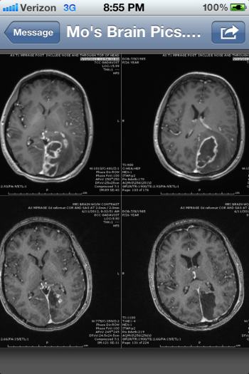 Top photos: Post-transplant, pre-brain surgeries, May 2012. Bottom photos:  Post-transplant, and two craniotomies (brain surgeries).